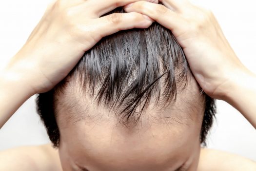 Easy Remedies For Preventing Hair Loss In Men